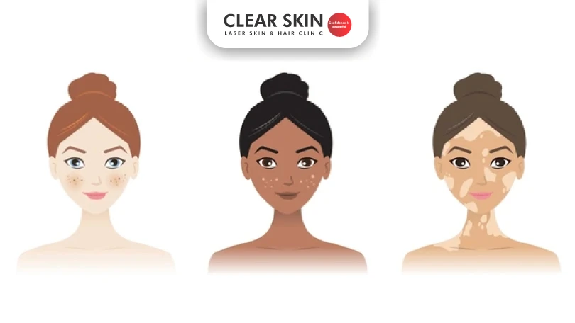 What are the types of skin pigmentation