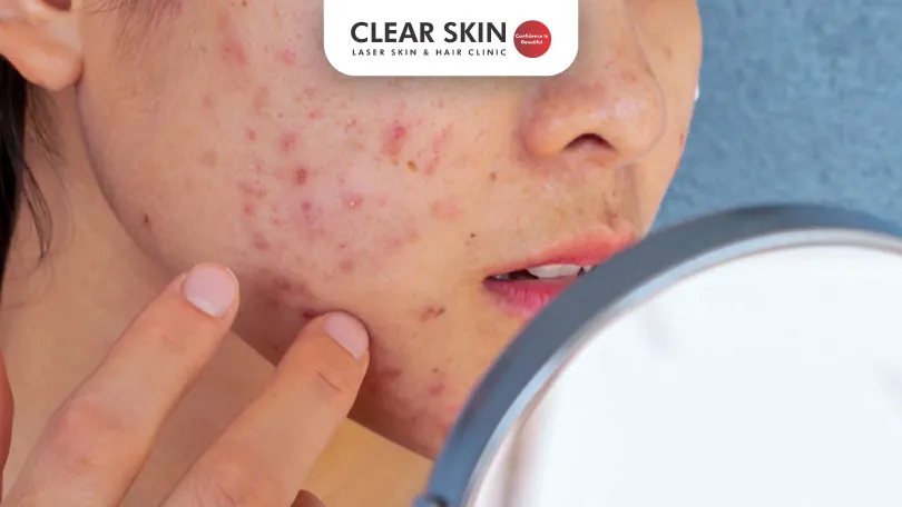 What-is-Acne-Prone-Skin-Understanding-Causes-&-Treatments-Clear-Skin-Pune What-is-Acne-Prone-Skin-Understanding-Causes-&-Treatments-Clear-Skin-Pune