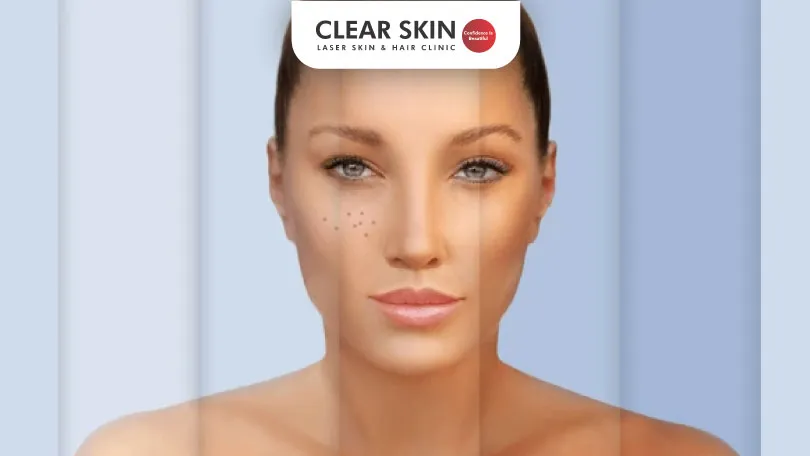 What is the Difference between Tanning and Pigmentation Clear Skin Pune