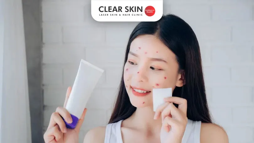 What-is-the-best-face-wash-for-acne-prone-skin What is the best face wash for acne prone skin