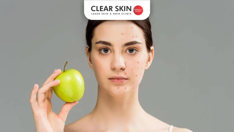 What is the link between acne and diet