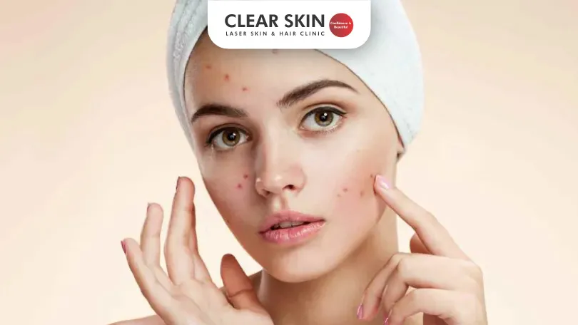 Why-My-Acne-Is-Not-Going-Away-Clear-Skin-Pune Why My Acne Is Not Going Away Clear Skin Pune