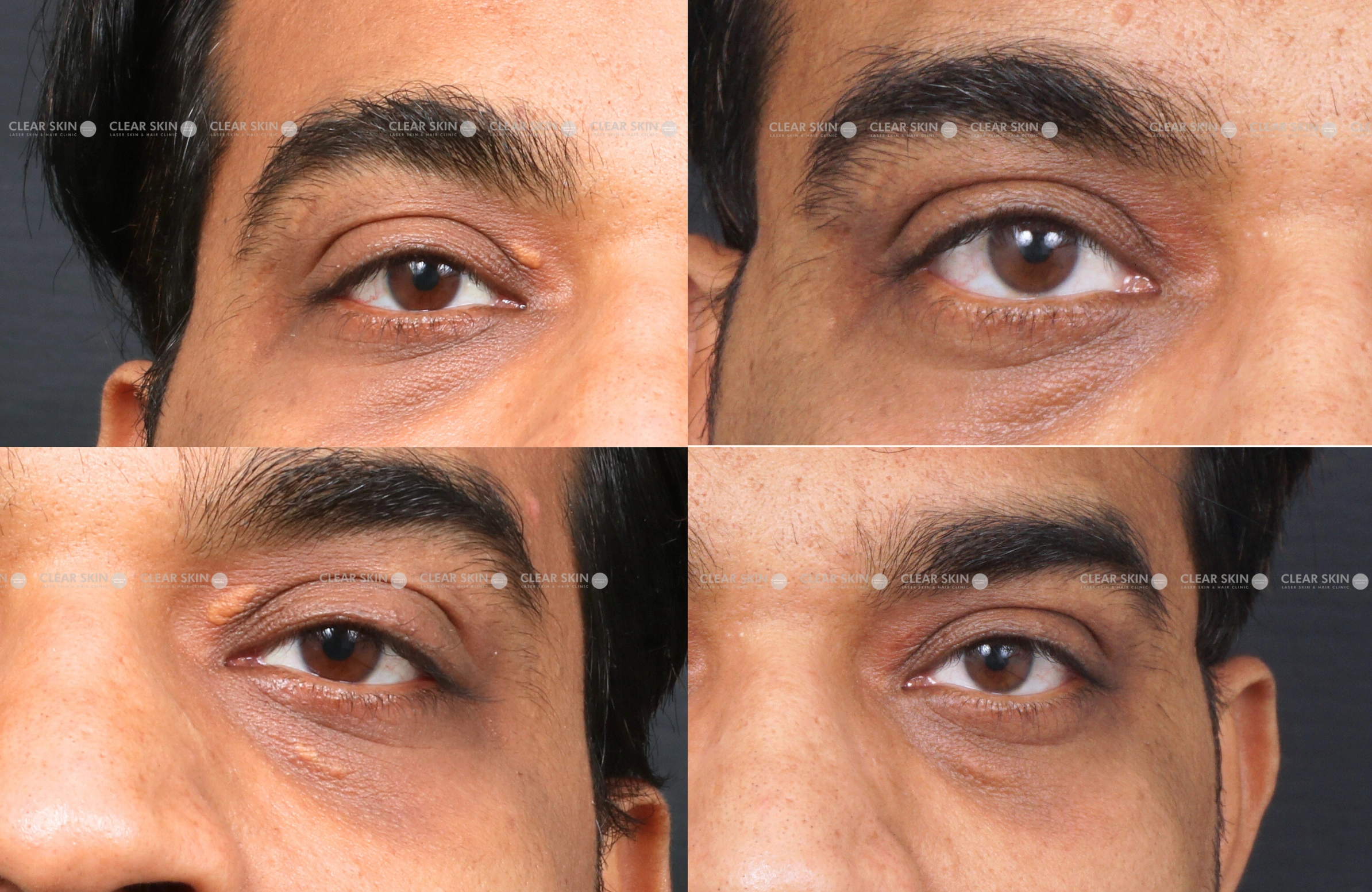 Xanthalasma Results 9 Months Timeline 9 Sessions ClearSkin Pune (2)