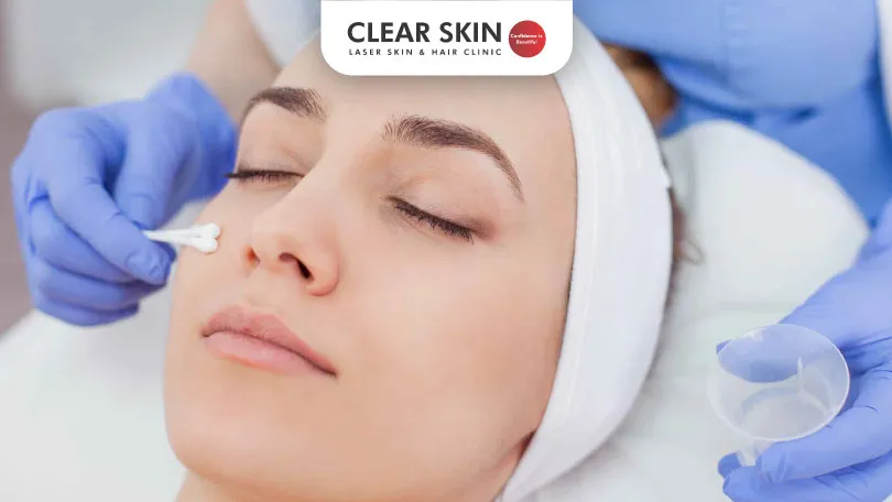 Chemical Peels for Melasma