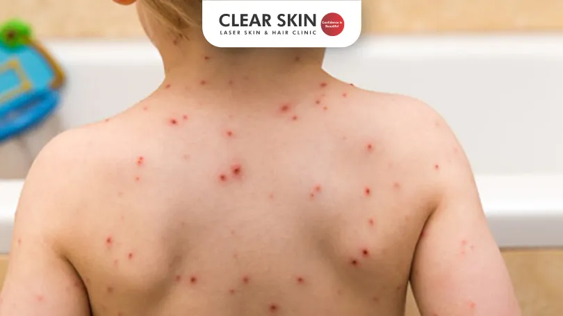 overview-of-chicken-pox-Clear-Skin-Pune Chicken Pox Overview