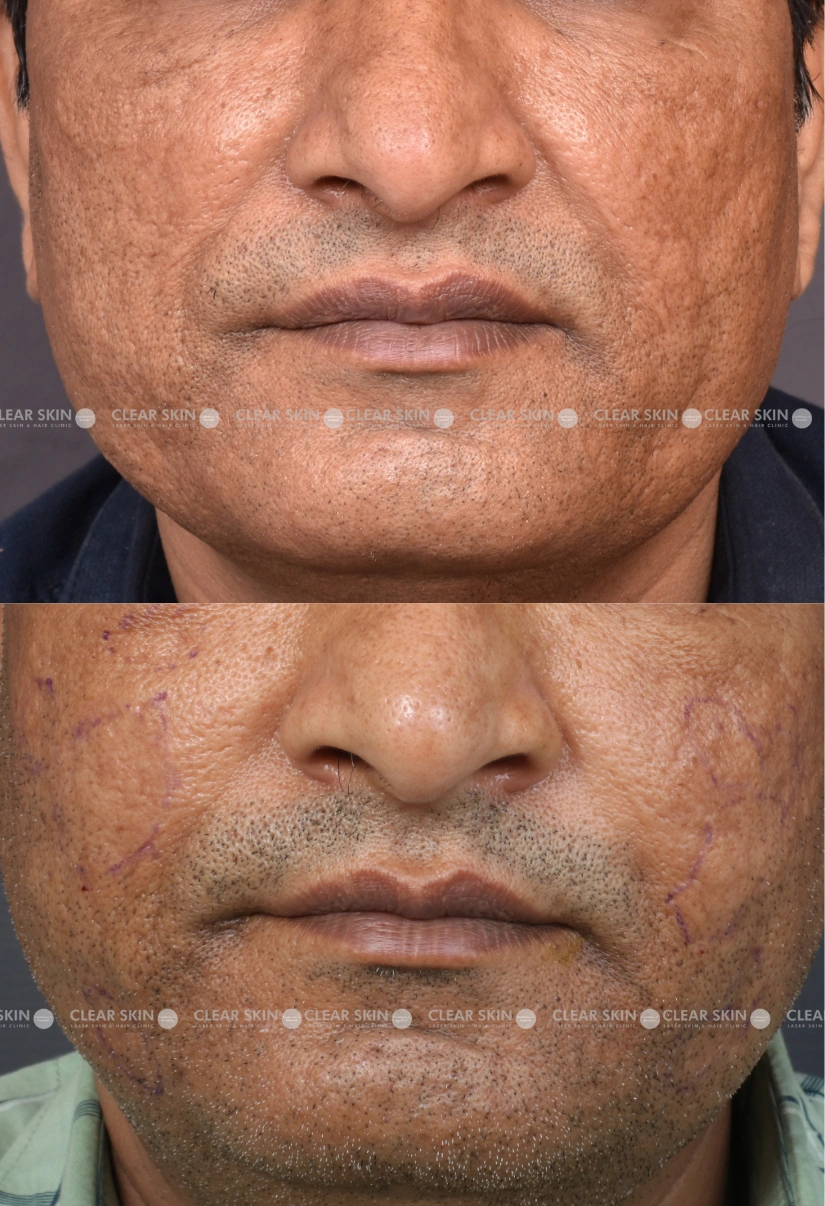 37yrs male Acnescars Results 3 Months Timeline 5 Sessions ClearSkin Pune