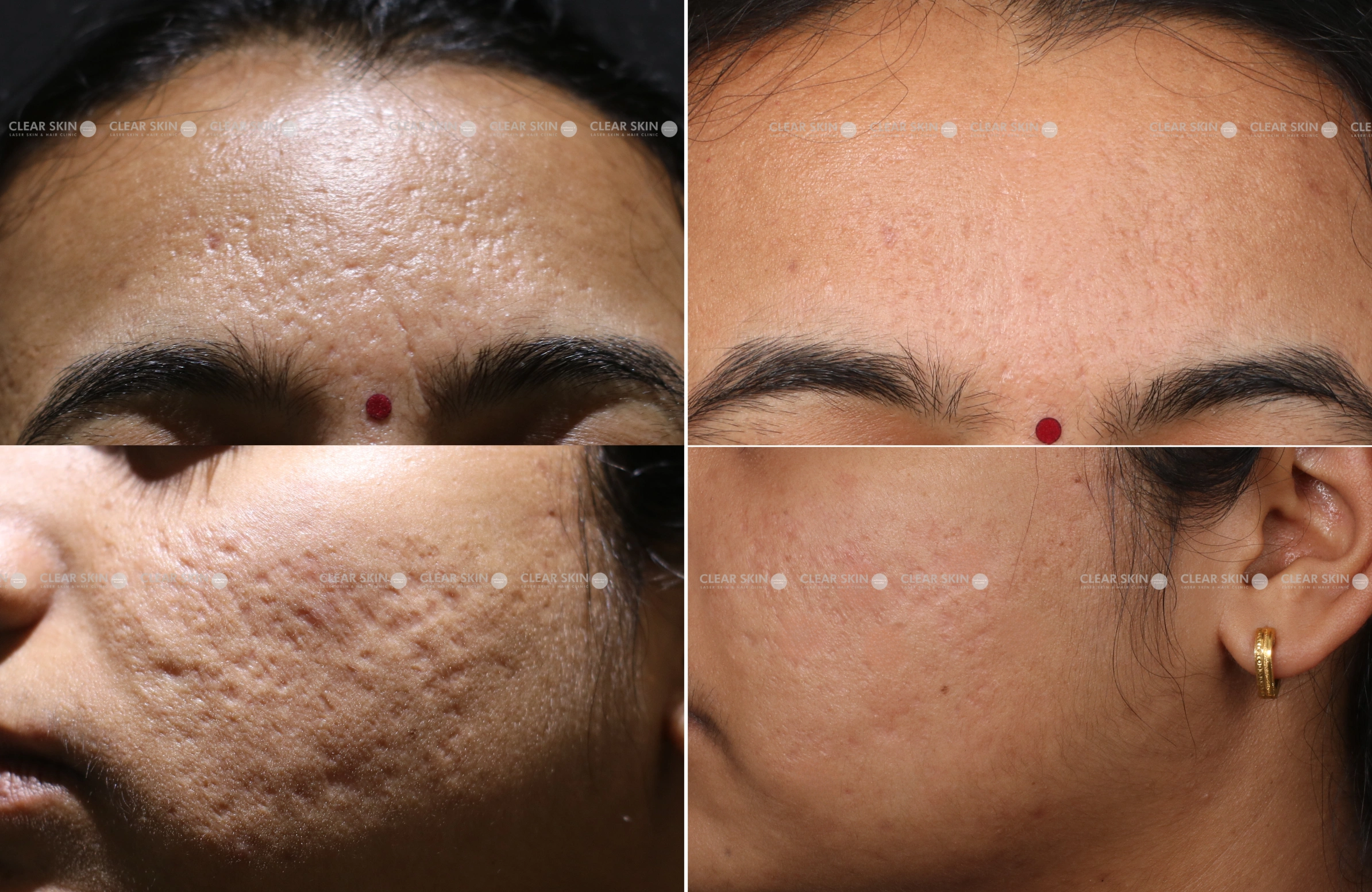 Acne Scars Before And After Laser Laser Treatment For Acne Scars Acne Scars Before And After Laser Laser Treatment For Acne Scars