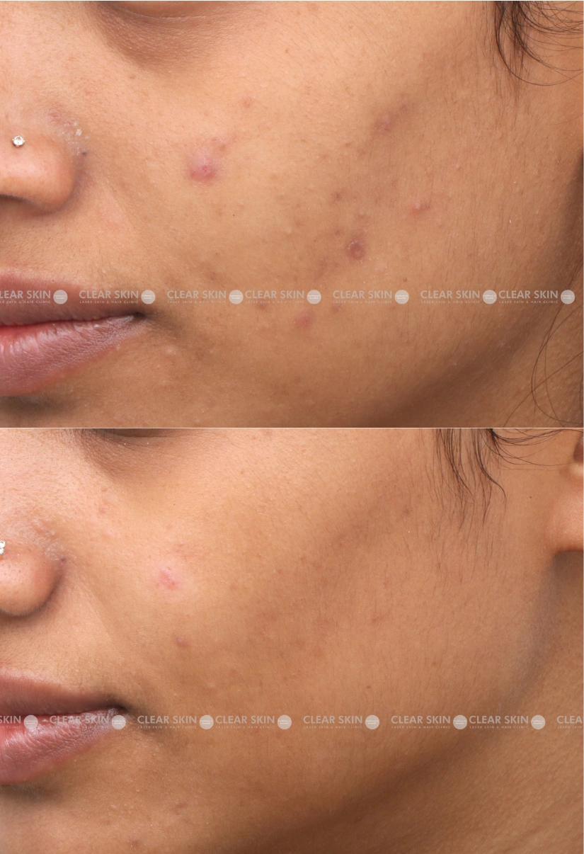 29yrs Female Chicken Pox Scar Results 6 Months Timeline 7 Sessions ClearSkin Pune