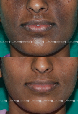 24yrs Female Pigmentation Results 2 Months Timeline 2 Sessions Clear Skin Pune