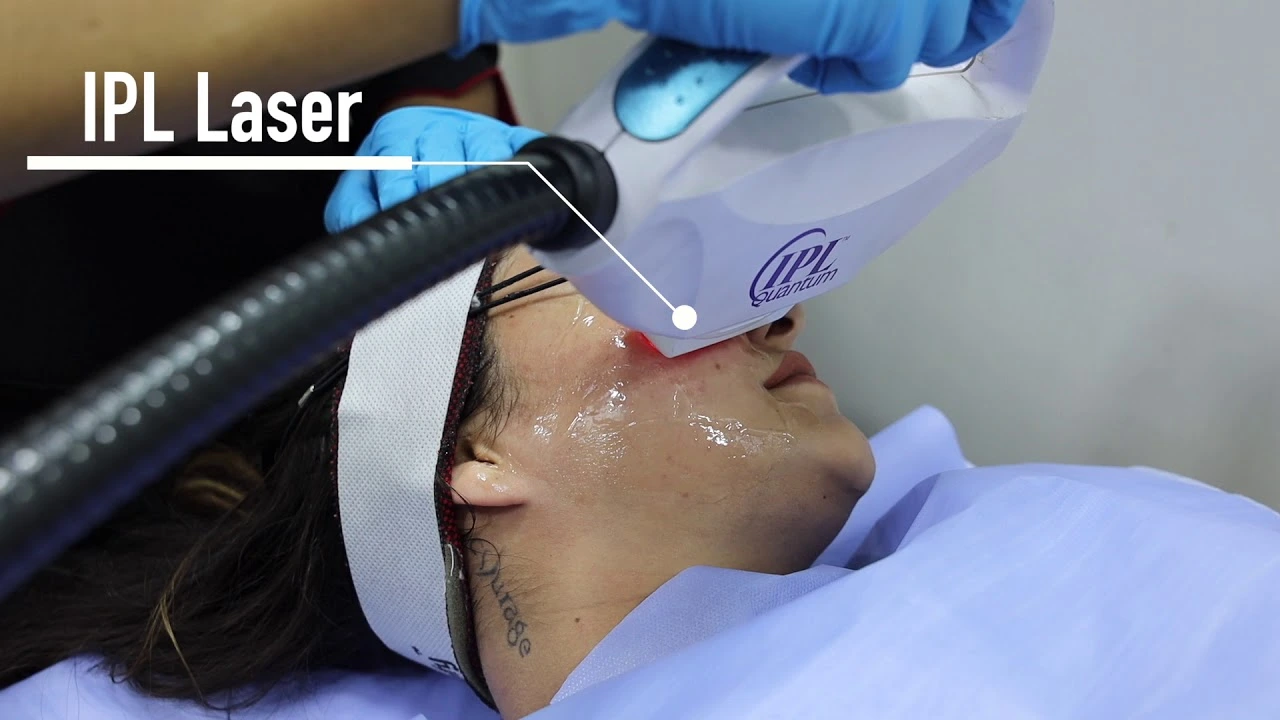 IPL for acne pimple