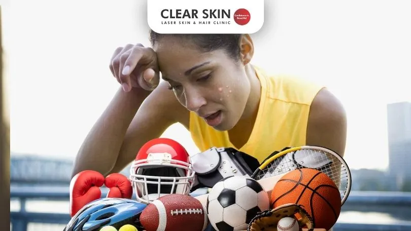 Is Sports Equipment Causing Your Acne