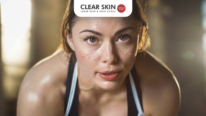 MicrosoftTeams-image Is workout causing your acne?