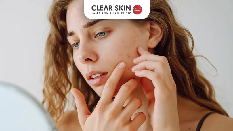 Does Makeup Cause Acne-Prone Skin?