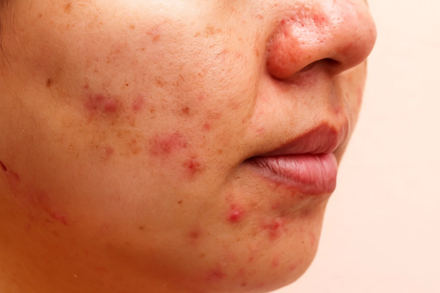 acne spot