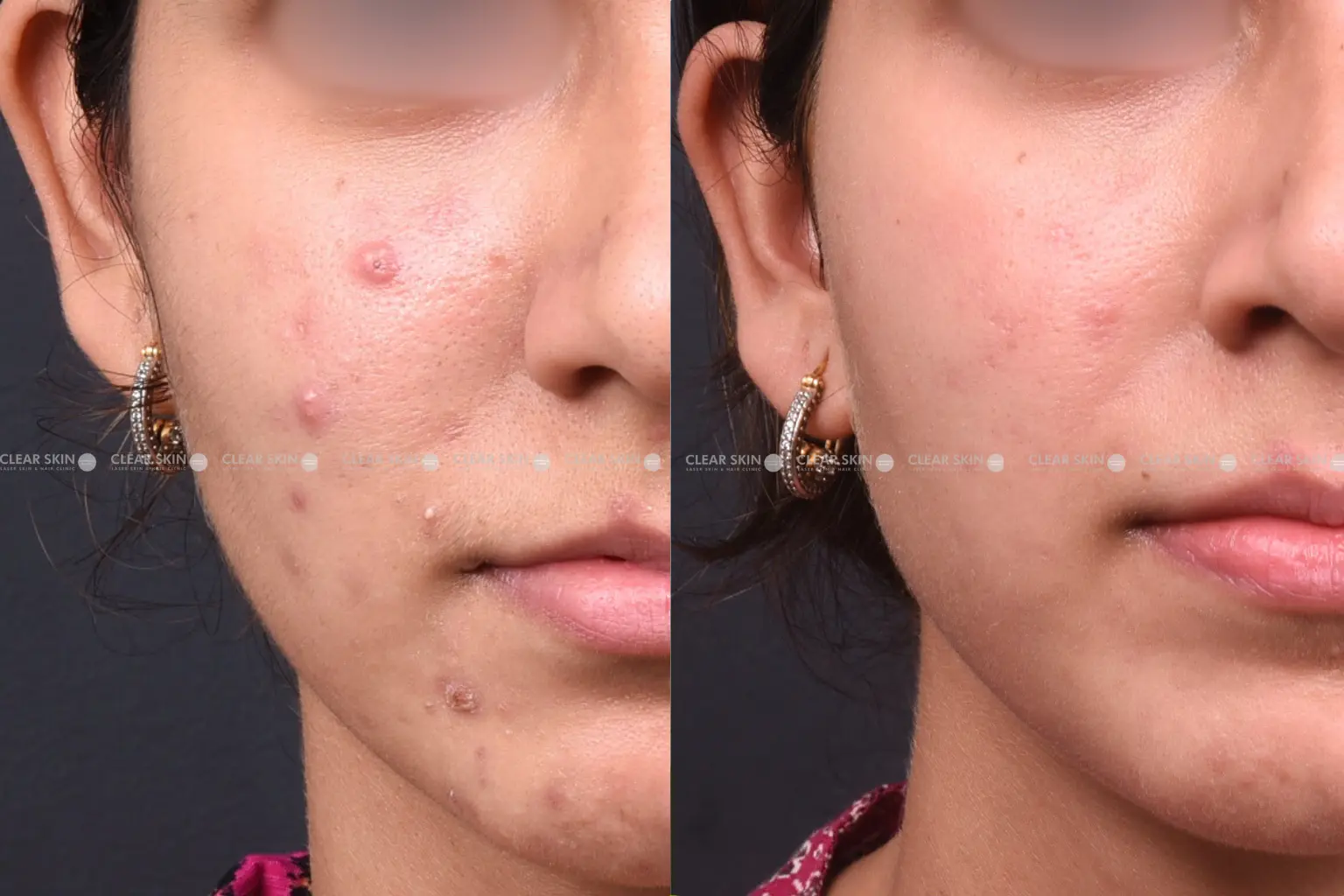 Acne Before After Pics