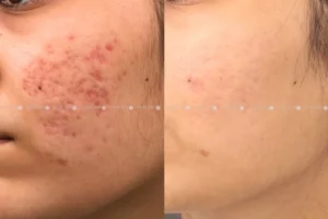 Acne Scars Before And After