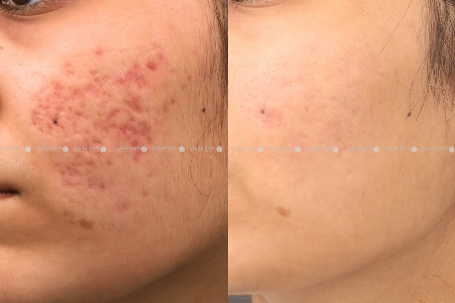 Acne Scars Before And After