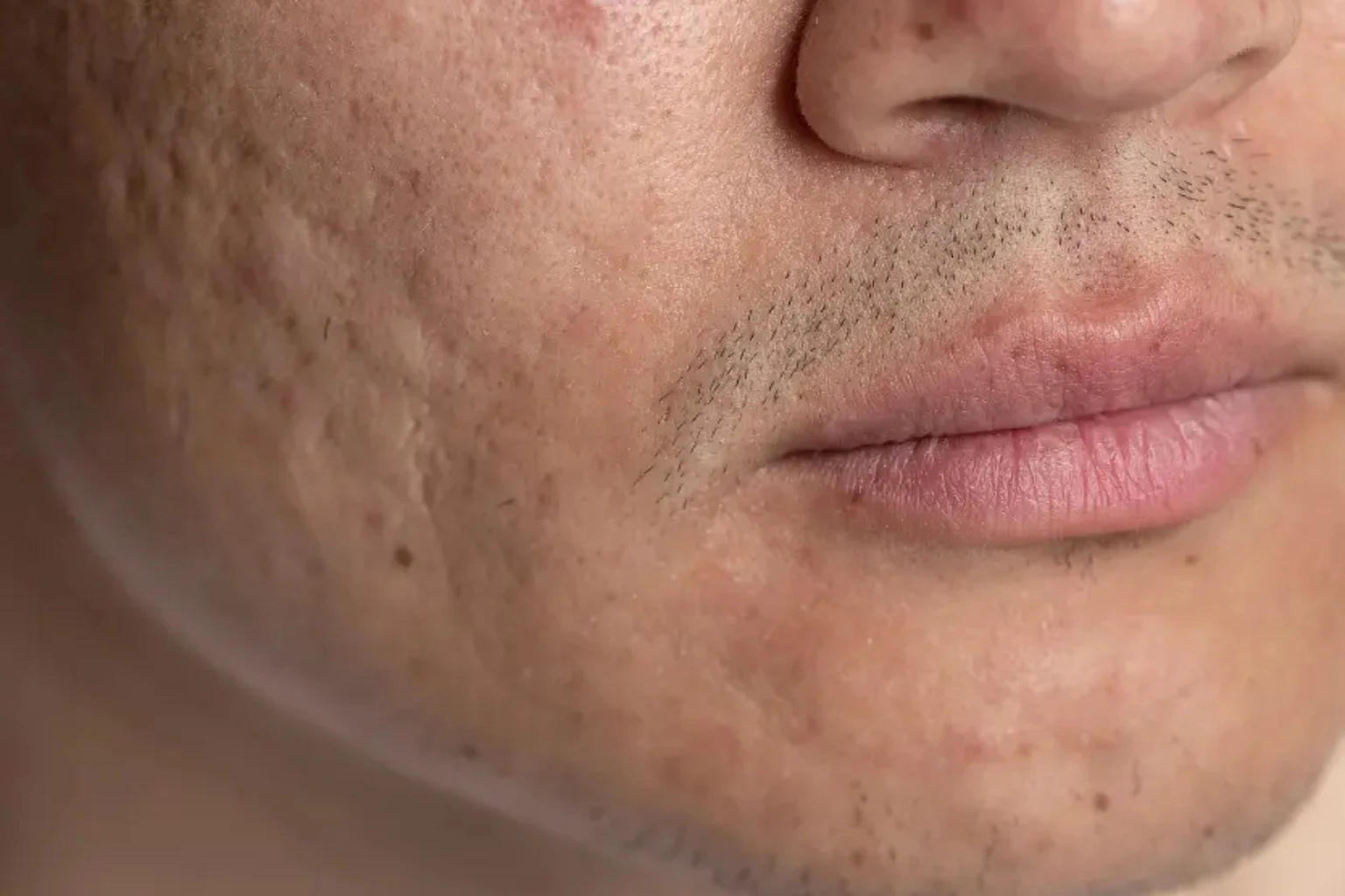 Acne Scars