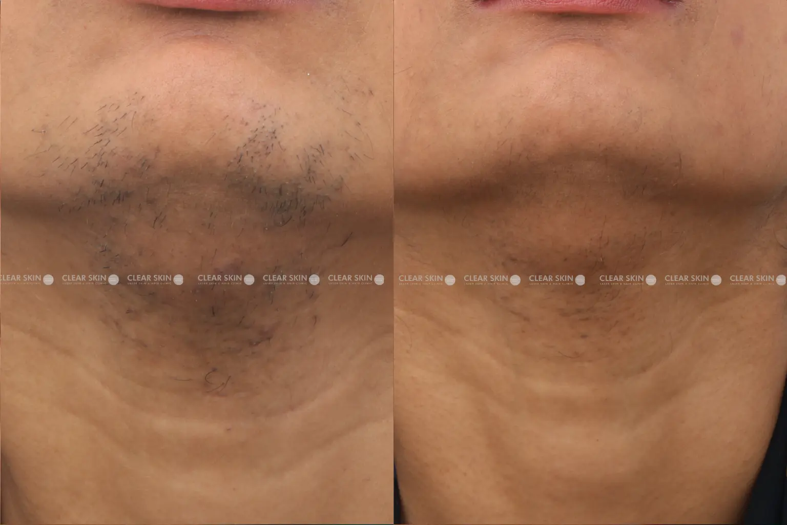 Laser Hair removal Before And After