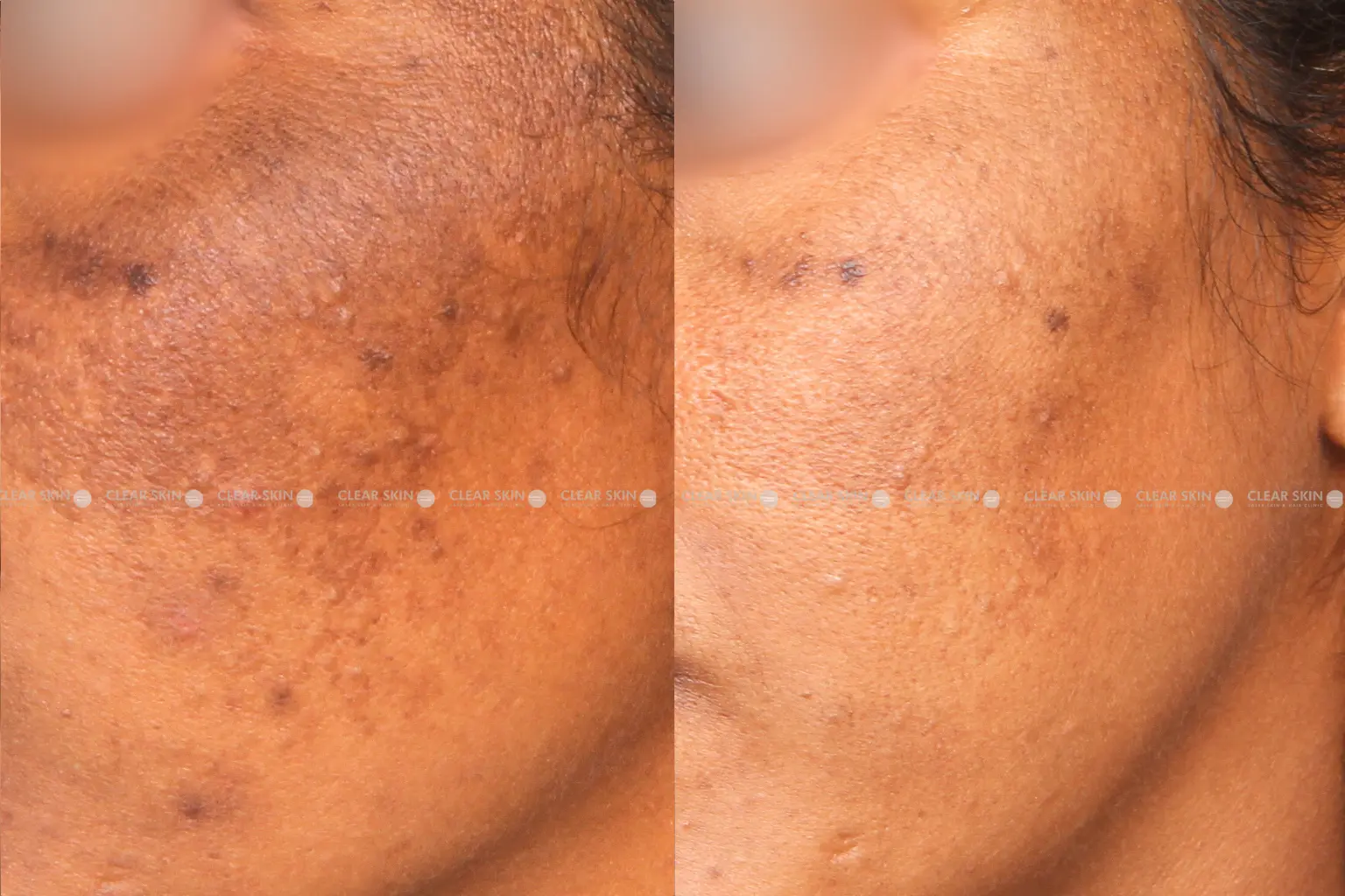 Melasma Before And After