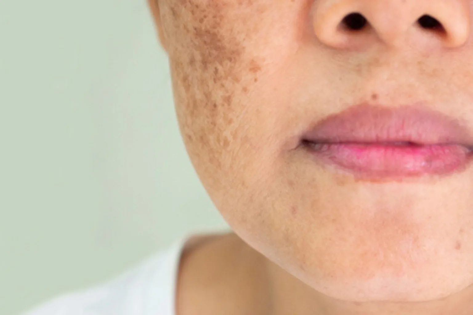 Melasma