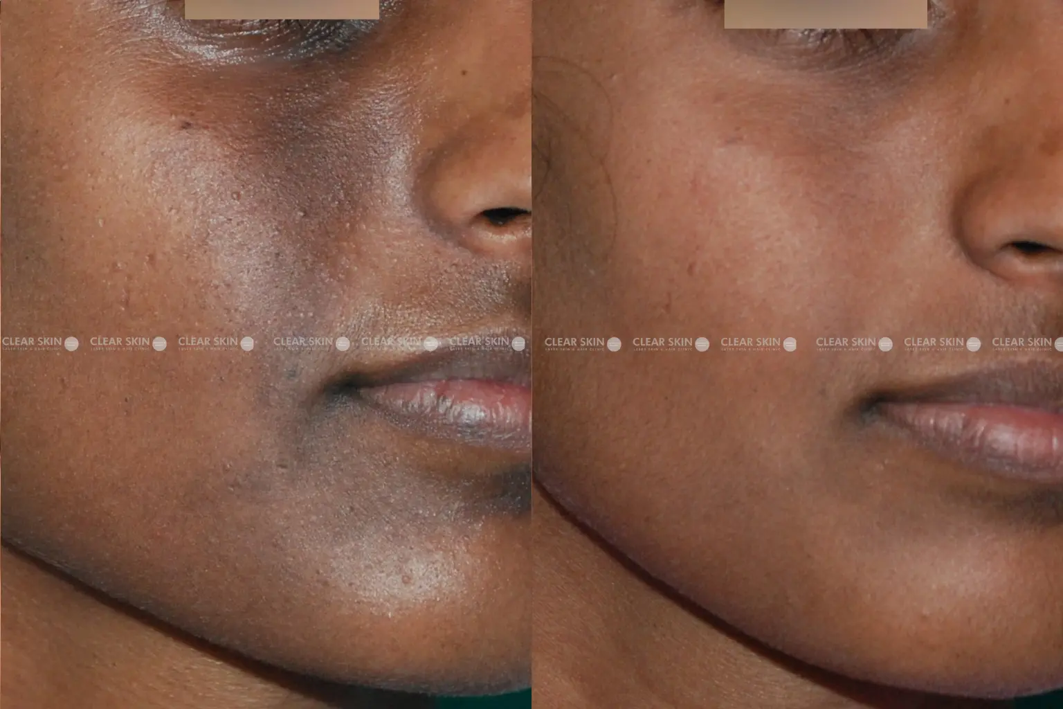 Pigmentation Before And After