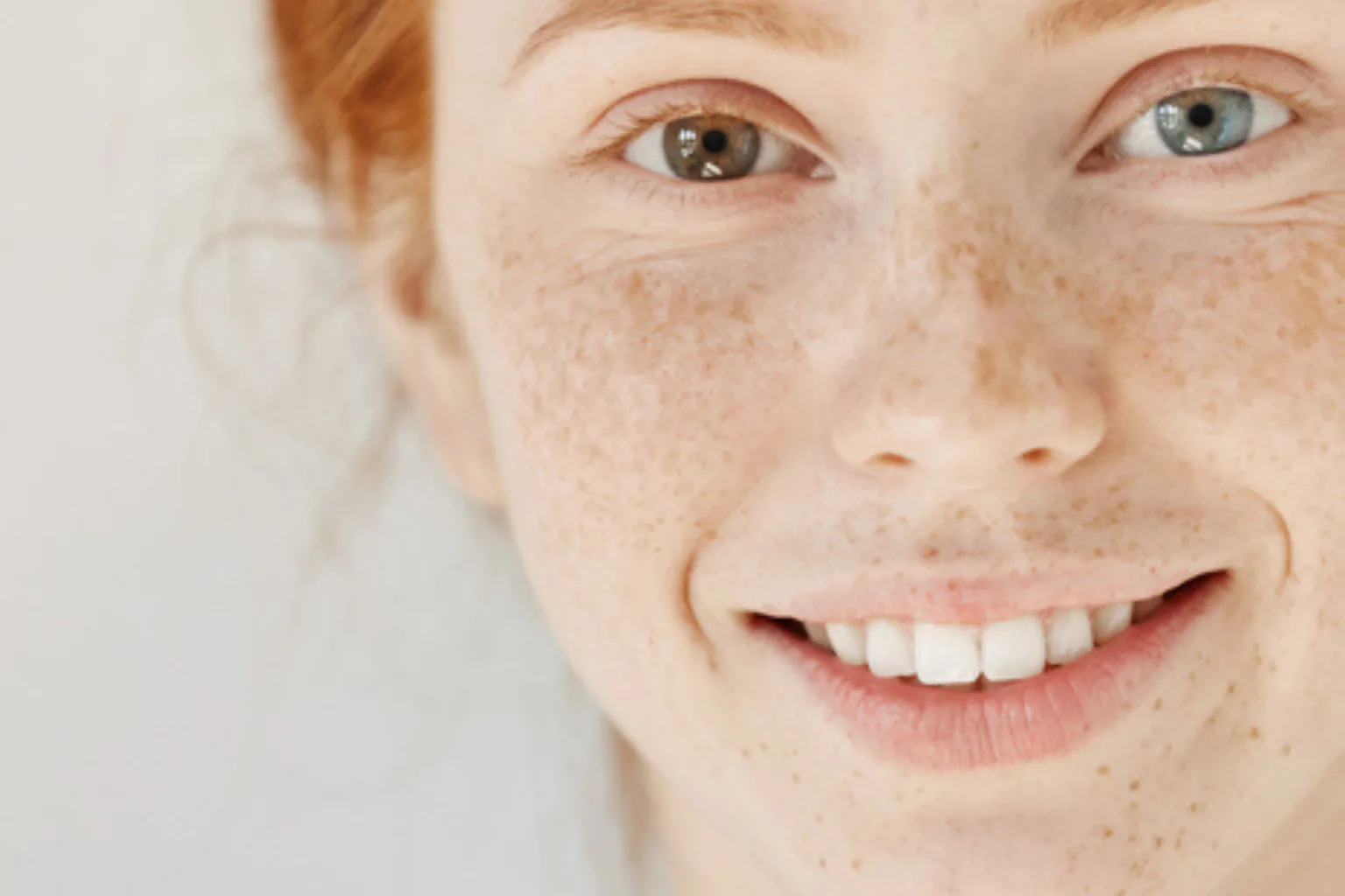 Skin Pigmentation