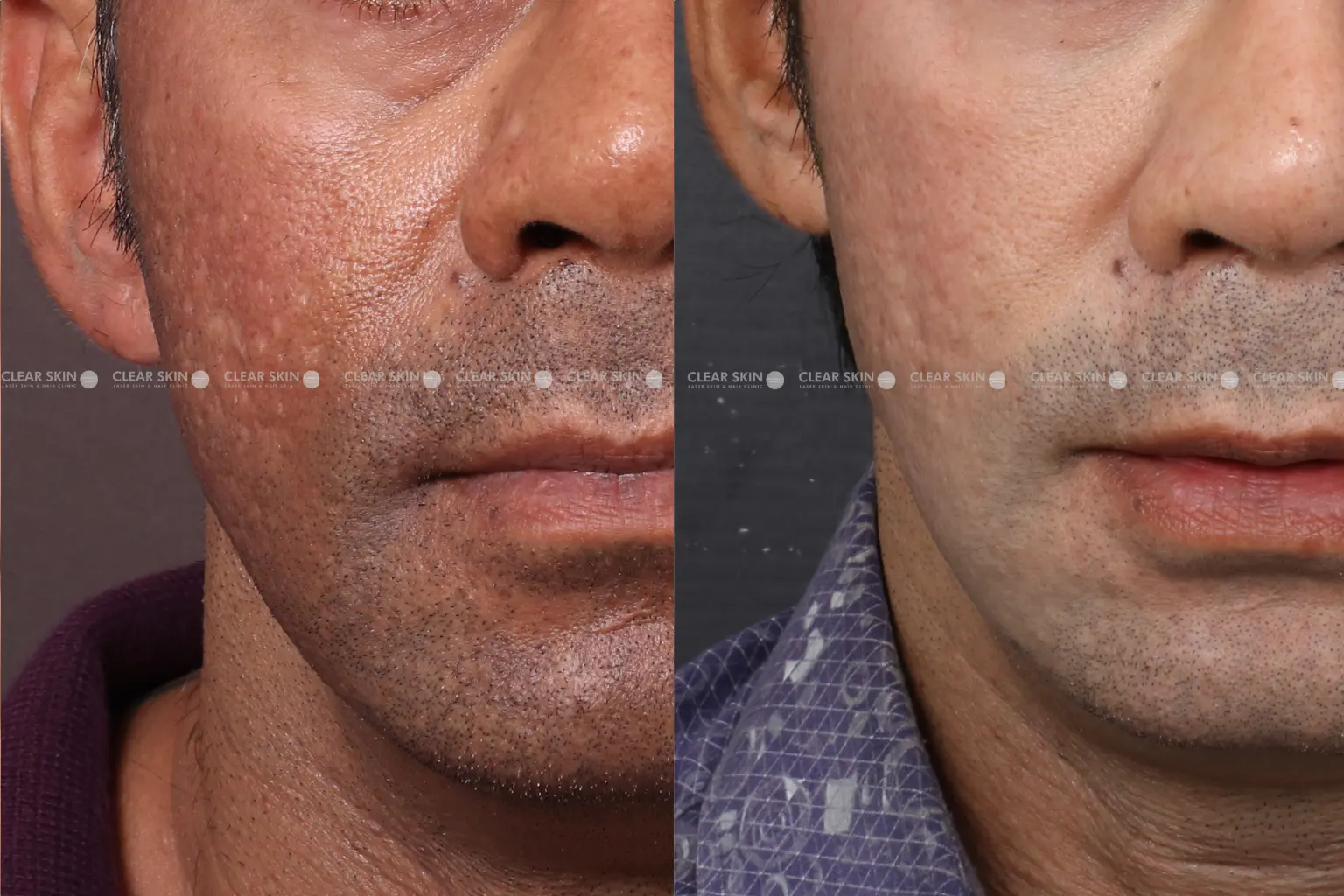 Skin Rejuvenation Before And After
