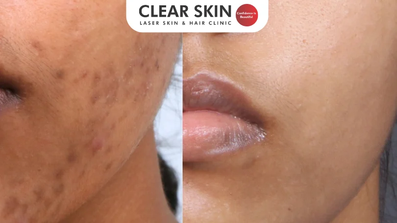 Acne treatment timeline showing results at 4, 8, and 12 weeks in Pune