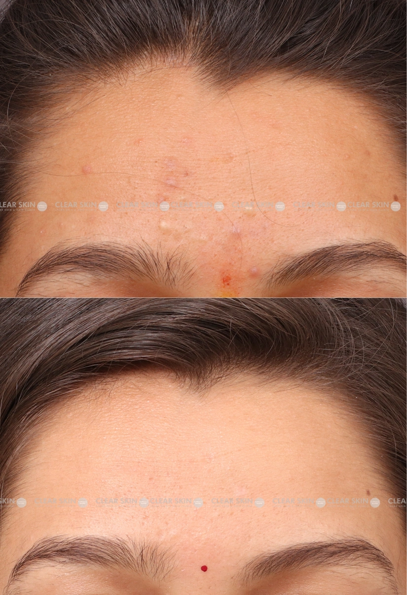 25yrs Female Acne Results 3 Months Timeline 3 Sessions ClearSkin Pune (3)