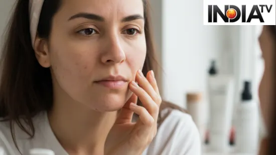 "Adult acne is rising in India and stress may be the biggest trigger, explains Pune-based dermatosurgeon<br />
"