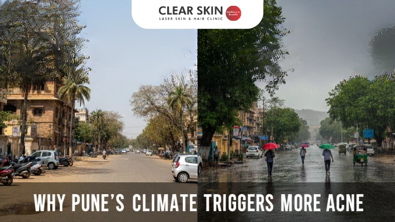 Why Pune’s Climate Triggers More Acne Breakouts Than Other Cities