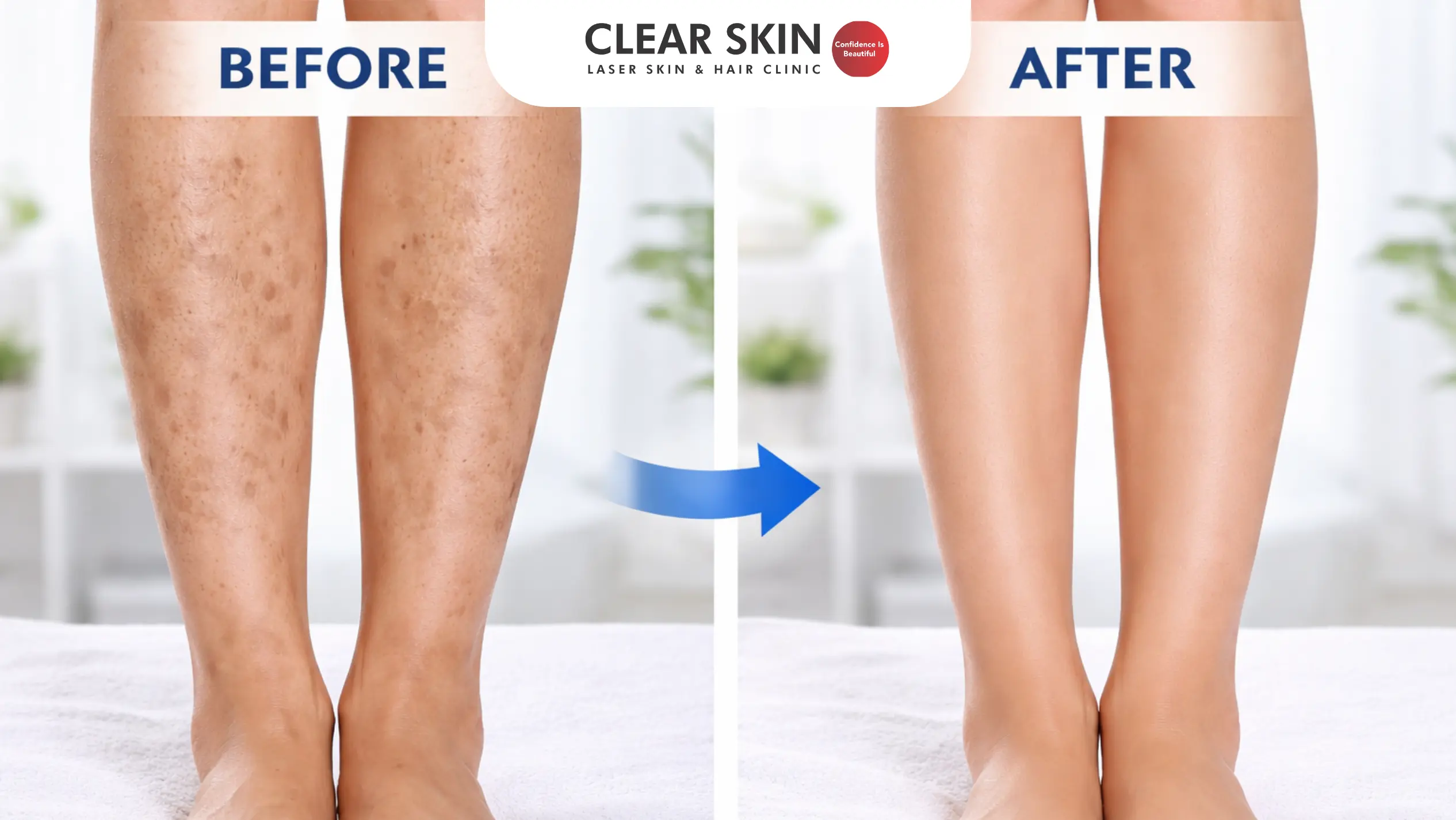 Before and after dark spot treatment on legs at Clear Skin Clinic Pune showing pigmentation reduction