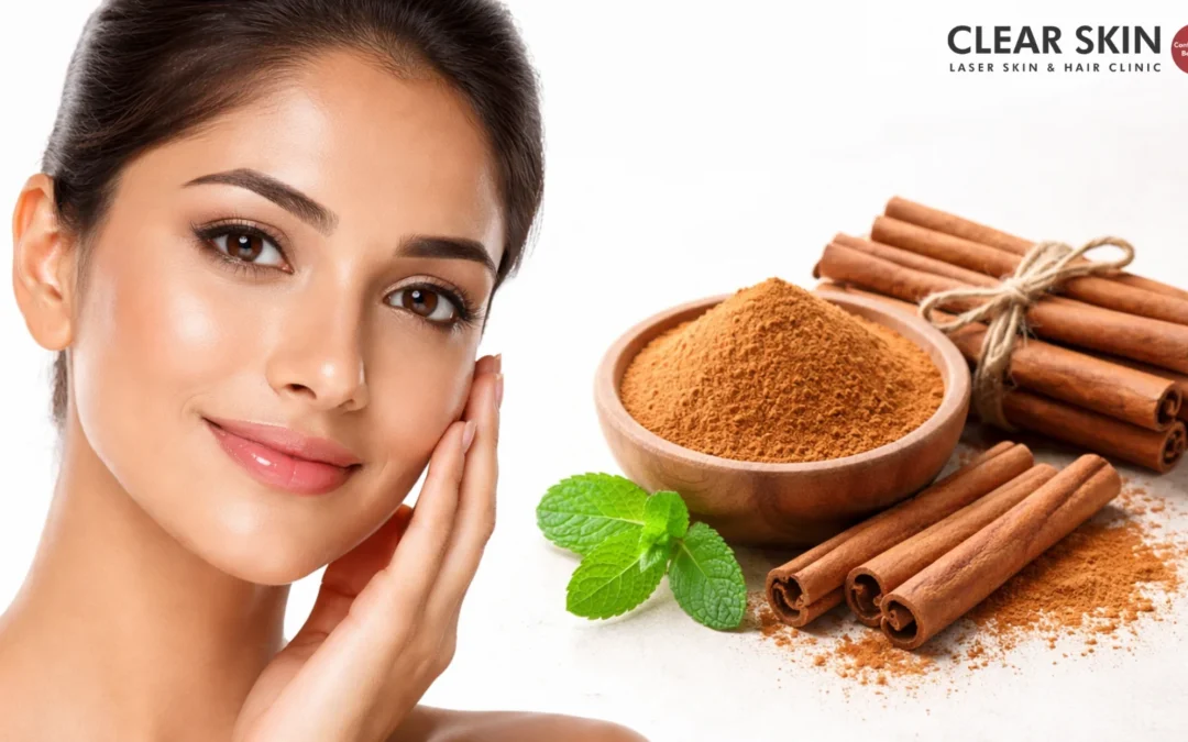 Cinnamon for Acne: Effective Home Remedies That Actually Work