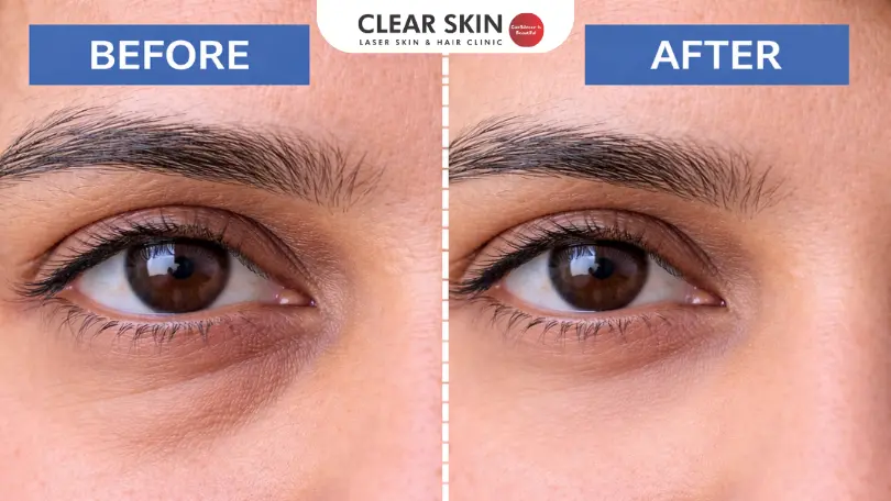 20 Tips to Say Farewell to Puffy Eyes and Feel Refreshed Again