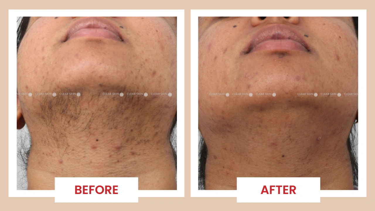 Laser hair removal before and after results showing hair reduction on Indian skin tone patient after 6 sessions at Clear Skin Clinic