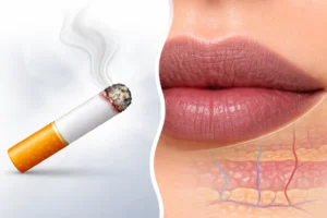 Smoking causes dark lips by reducing blood flow to lip tissue