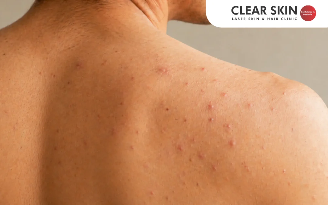 How to Get Rid of Shoulder Acne Fast?