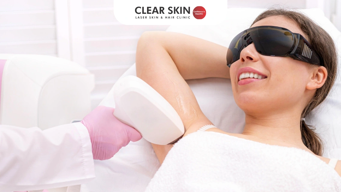 Laser hair removal treatment at Clear Skin Pune clinic using diode laser technology