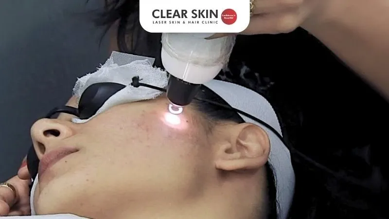 Q-Switch Laser Cost in Pune: Price & Results Guide