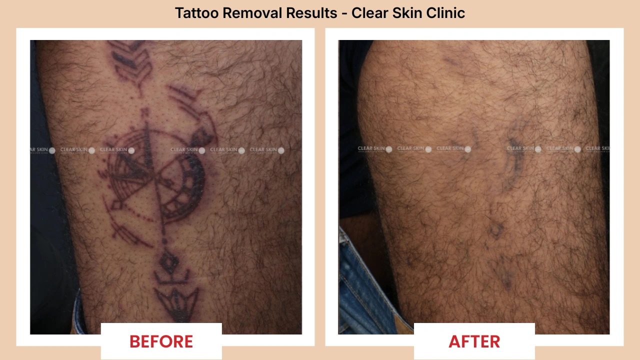 Tattoo removal results progression across sessions at Clear Skin Pune.