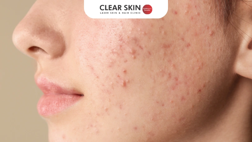 Acne is a chronic inflammatory skin