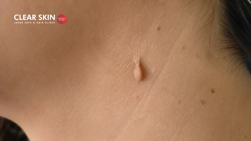 Skin tag Removal