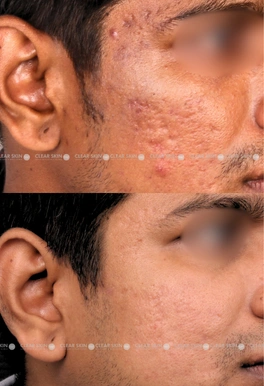 acne scar laser treatment before and after pictures
