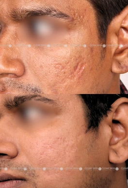 acne scar removal before and after pictures