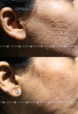 acne scar treatment before and after