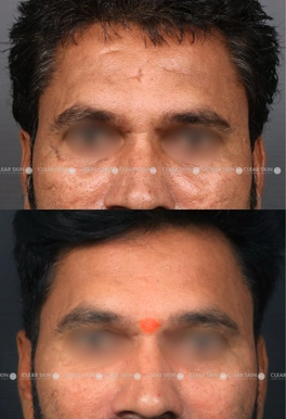 acne scars before and after chemical peel