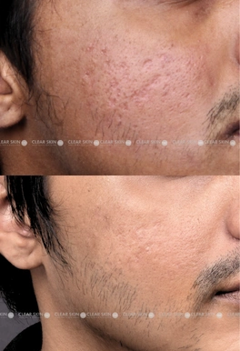acne scars before and after co2 laser