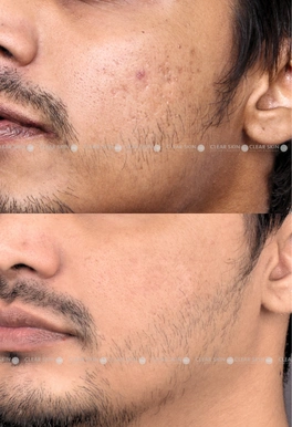 acne scars before and after laser results