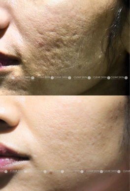 acne scars before and after laser resurfacing